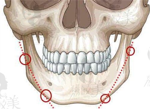 广州罗延平做下颌角手术怎么样？罗延平长曲线下颌角截骨只要29650