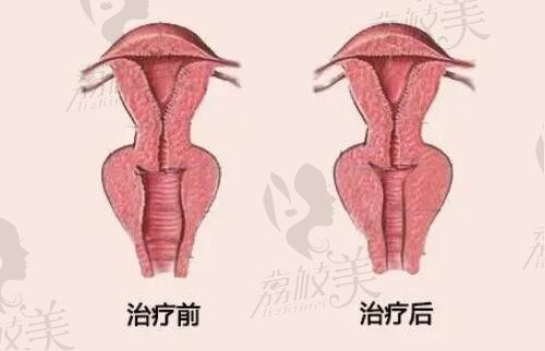 韩国好手艺妇科私密整形价格泄露,子宫复位/缩阴手术价格不太贵