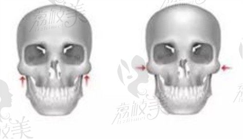 韩国欧佩拉医院做轮廓手术贵吗？从医院资质院长及价格上分析