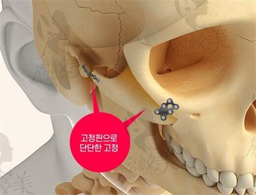 韩国轮廓整形必来1%(百分之一)整形外科,不光因为技术好风格自然