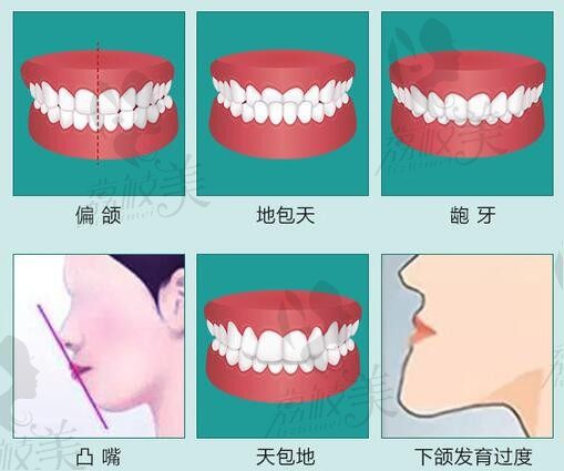 广州广大何锦泉正颌手术、正牙塑脸解决骨性龅牙\地包天\开颌问题