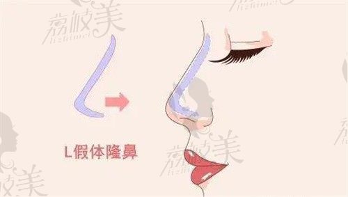 武汉五洲整形做鼻子怎么样？胡乔和王志做鼻整形/鼻修复技术强