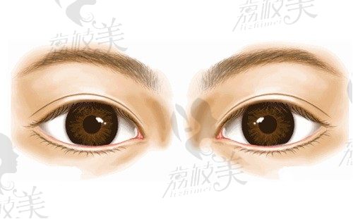 武汉项利姣做双眼皮做的咋样？起价17600元的美眼综合技术效果双绝！