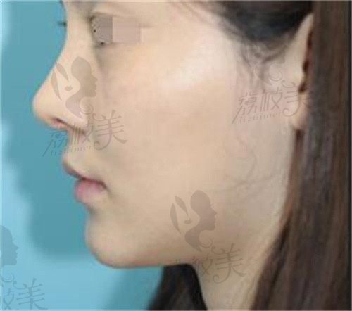 韩国碧夏李珉奭鼻子修复真挺好,自体肋软骨45000元起很自然！