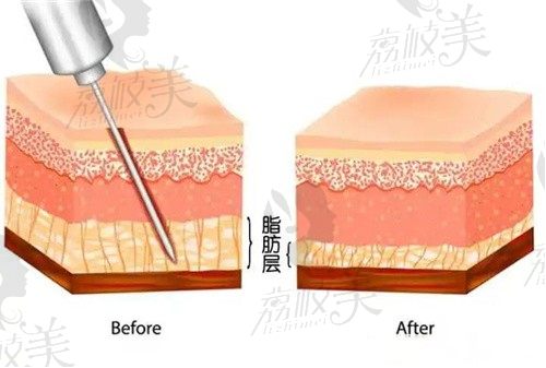 武汉仁爱时光整形属于正规医院吗？抽脂怎么样？整形价格表奉上