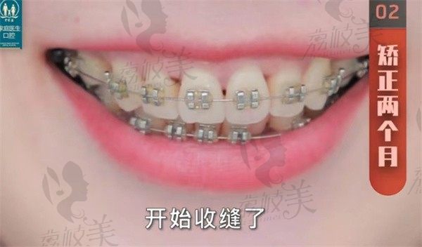 广州中家医口腔医院怎么样？我做了金属矫正感觉很可靠还不贵