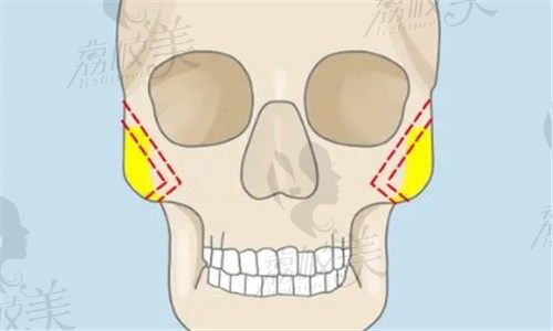 武汉赵贵庆颧骨内推怎么样？颧骨颧弓内推只要71520起技术好不下垂