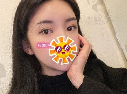 分享韩国DA整形医院做面部轮廓全过程，李相雨院长面部轮廓技术超赞