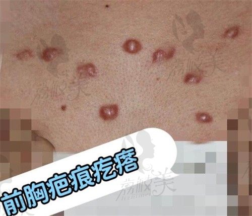 上海胡鸿泰医生怎么样,手术祛疤痕疙瘩创面小防复发！