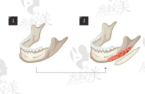 分享我在韩国id做轮廓整形真实经历，做颧骨内推+下颌角整形真赞