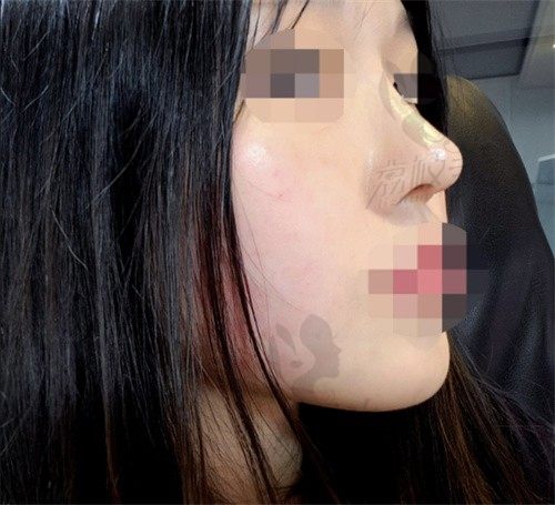 韩国百利酷VS优雅人鼻部修复大比拼，看哪家的鼻修复技术更好？