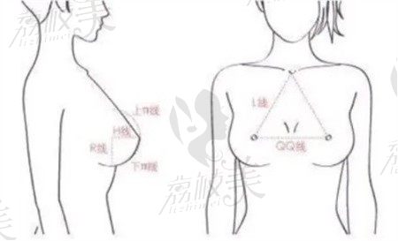 杭州整形医院孙豪隆胸擅长乳房下皱壁切口，假体隆胸技术好5W起可做