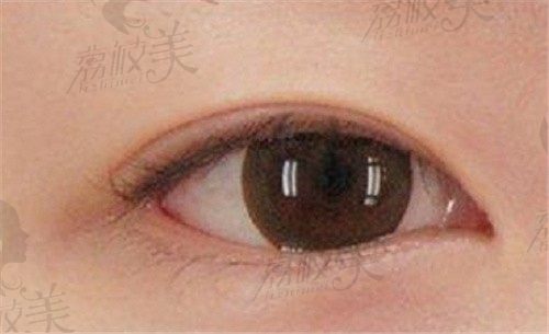 韩国清潭first整形外科做双眼皮厉害，我找成镇模做的双眼皮超自然