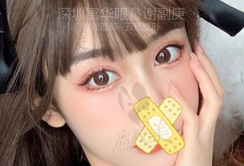 深圳富华谢福庚医生做眼睛很出名，超自然的双眼皮案例仅7500元起