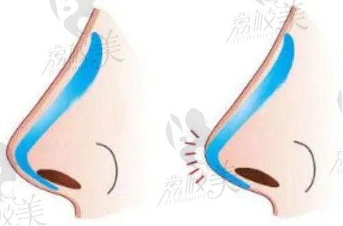 上海李鸿君做鼻子风格自然，半肋鼻综合塑鼻尖技术好价格只要3.5w