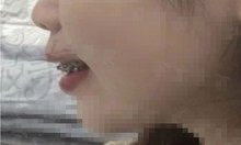 在江门壹心维美口腔整牙2年多，惨不忍睹的侧脸终于有救了