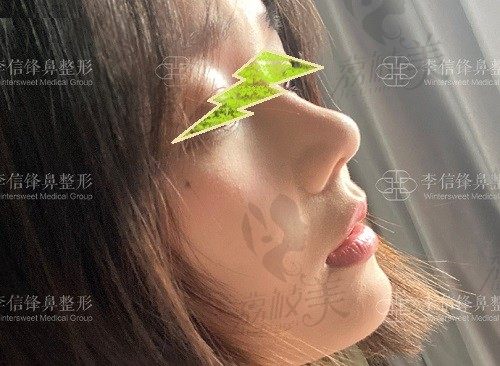 深圳李信鋒鼻子做得好嗎？整理匯總李信鋒隆鼻范例圖及鼻綜合價(jià)格