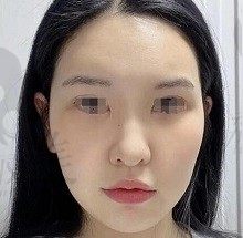 手术前