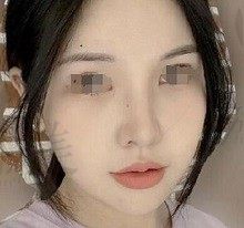 手术后