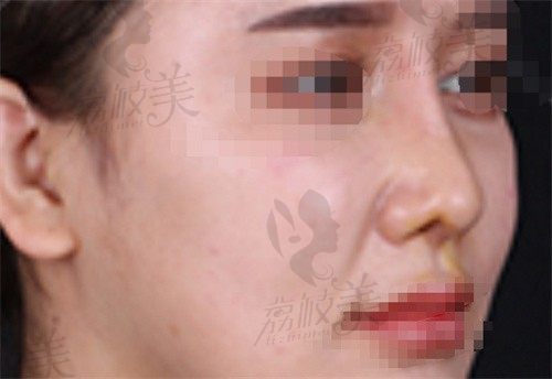分享西安国医整形师俊莉为我做的鼻修复实例，都评价她做鼻子很自然