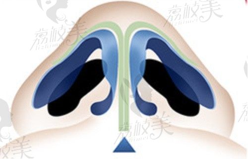 上海谢卫国做鼻子怎么样？起价7w的肋软骨隆鼻技术好外观自然