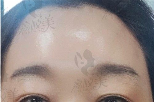 手术后