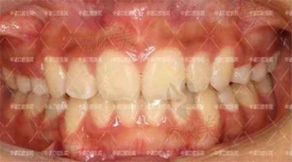 石家庄中诺口腔医院不是公办的，但给女儿做了隐形矫正发现技术不赖