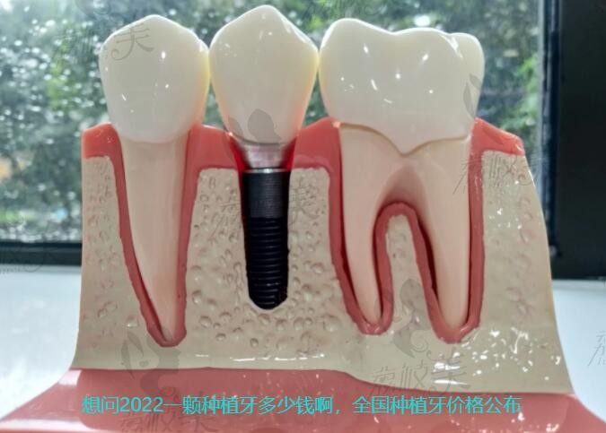 想问2022一颗种植牙多少钱啊，全国种植牙价格一览表里查