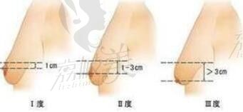 揭底杭州乳房下垂上提手术比较好的医院，附各院胸部下垂矫正费用