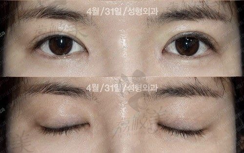 韩国431整形医院眼整形修复技术超牛，看完我的眼修复过程深有体会