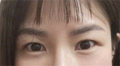 去韩国BK整形找金炳健院长做眼底脂肪重整,术后两周良好技术可信！