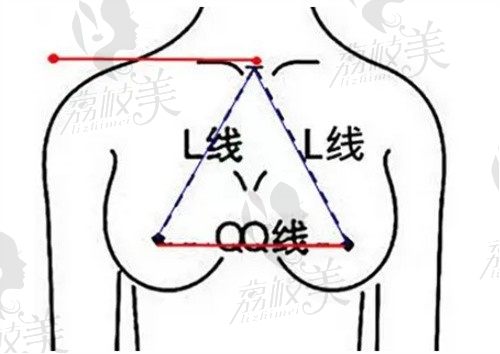 杭州薇琳徐少骏隆胸口碑好，自然动感的复合假体隆胸价格仅2.5W起 
