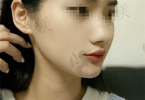 上海时光何晋龙磨骨审美好技术佳，看我做下颌角整形的真实经历