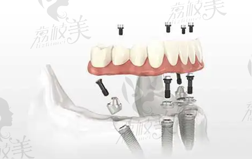 上海新菲口腔种植牙多少钱？韩国奥齿泰种植牙3980元起含牙冠
