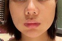 成都李继华磨骨实例术后反馈30天情况,轻微肿胀没啥后遗症！