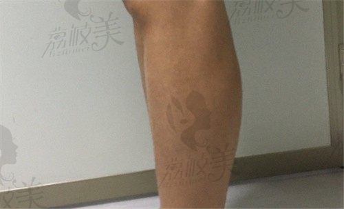 上海张怀军吸脂价格划算技术好，分享我做小腿吸脂手术全经历