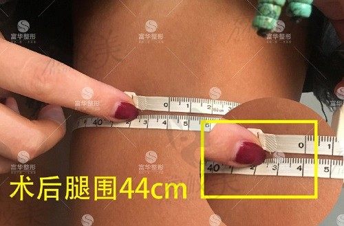 深圳富华谢福庚医生吸脂技术经验都很足，大腿环吸只有23800元起