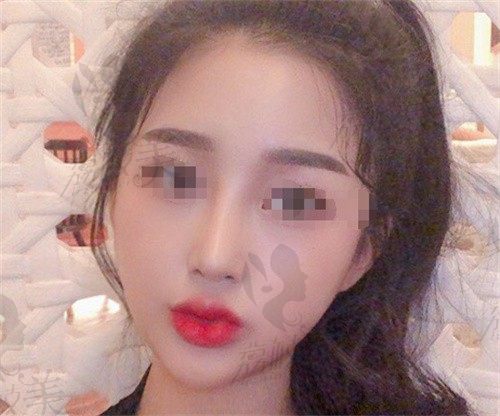 看我找韩国欧佩拉朴延涉做的轮廓三件套,术后脸小了一圈！