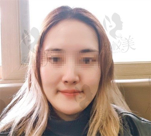 韩国欧佩拉做轮廓三件套就技术好价格划算，分享我做轮廓手术的经历