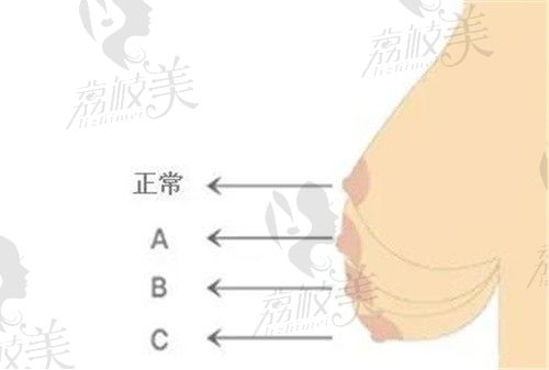 上海张建平隆胸价格划算技术好，做假体隆胸还能有效改善胸下垂