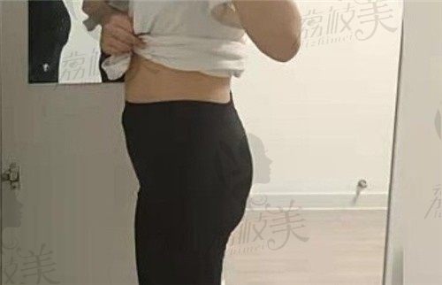 要问上海李旭东吸脂技术怎么样，瞧我做腰腹吸脂已经成了小蛮腰