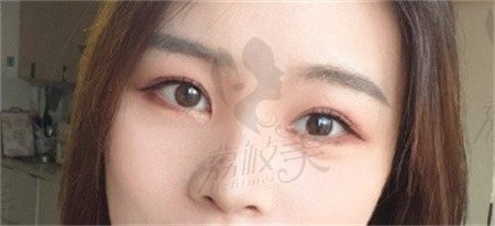杭州高士乾双眼皮修复技术好价格也公道，分享我做双眼皮修复全过程