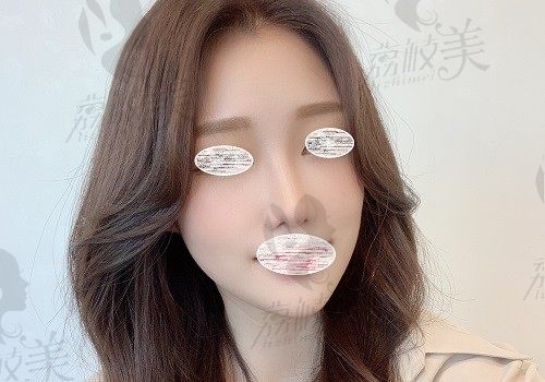 谈谈我在韩国欧佩拉做的鼻综合整形过程，悄悄变美真的不是梦
