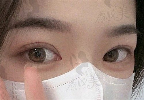 西安孙峰医生做双眼皮价格多少钱？据说他修复双眼皮技术厉害