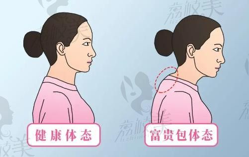 惠州詩璐醫(yī)療美容去富貴包怎么樣？微創(chuàng)一次性消除富貴包很厲害