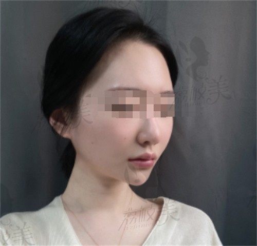 韩国欧佩拉整形医院好不好？看我找李昇禹院长做鼻整形全部过程