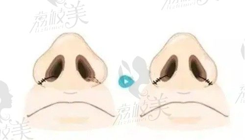 上海鼻头缩小整形医院哪家好？薇琳、美莱、华美做鼻头整形都靠谱