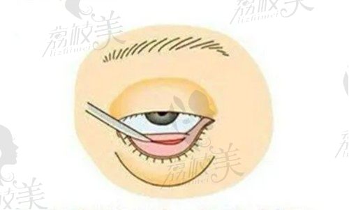 上海华美佀同帅做的眼整形怎么样？显微外切祛眼袋技术好起价23360元