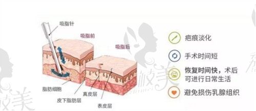 上海时光宋茂启胸部整形技术好，微创吸脂巨乳缩小手术21554元起