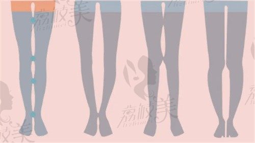 上海丽质卢九宁直腿成形术超赞，做直腿矫正技术好起价3.5w